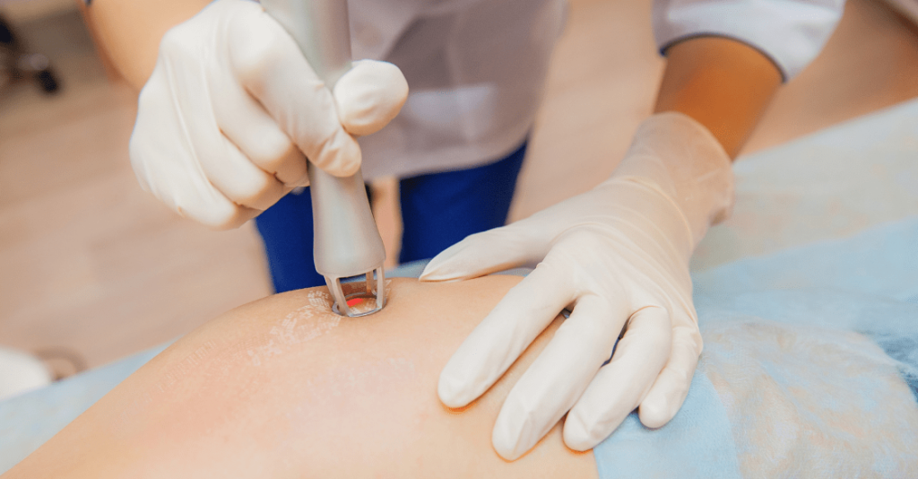 Laser stretch mark removal in san diego