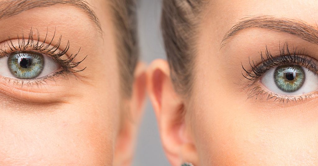 remove dark circles permanently