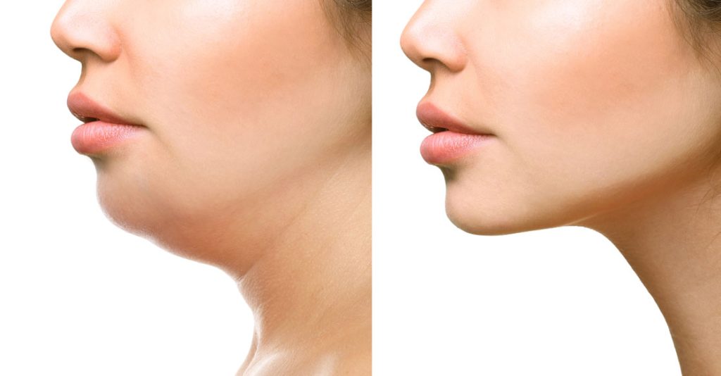 chin fat removal SDCoolsculpting