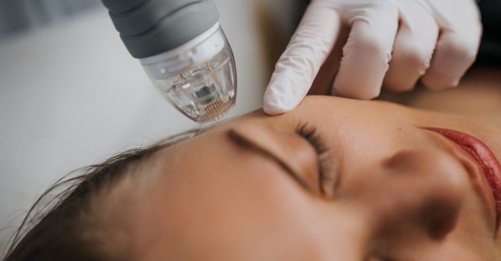 Plastic surgeon performing microneedling on a patient's face